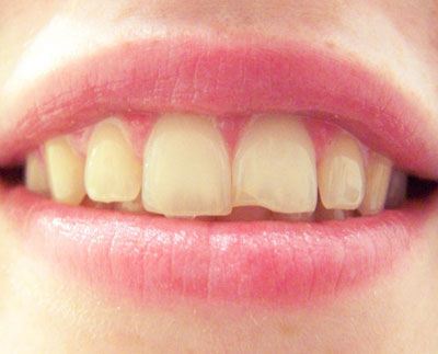 Cracked Tooth Repair - Broken Tooth Repair - Coral Springs Dentist