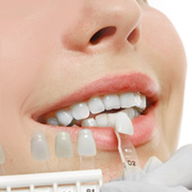 Teeth Whitening Boca Raton  Teeth Whitening for Braces West Boca
