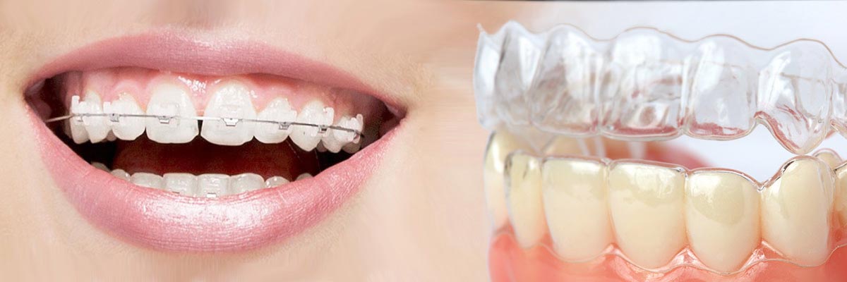 Braces VS Invisalign: Which One is Better For You? - Paradise Smiles